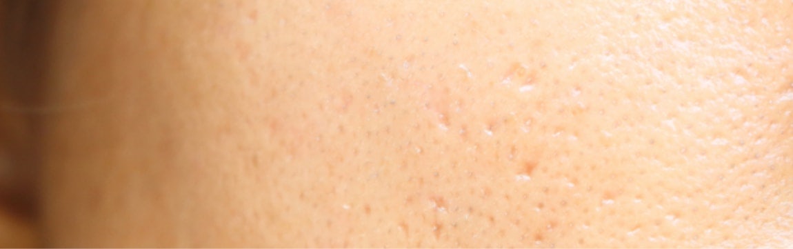 How to Minimize and Get Rid of Large Pores