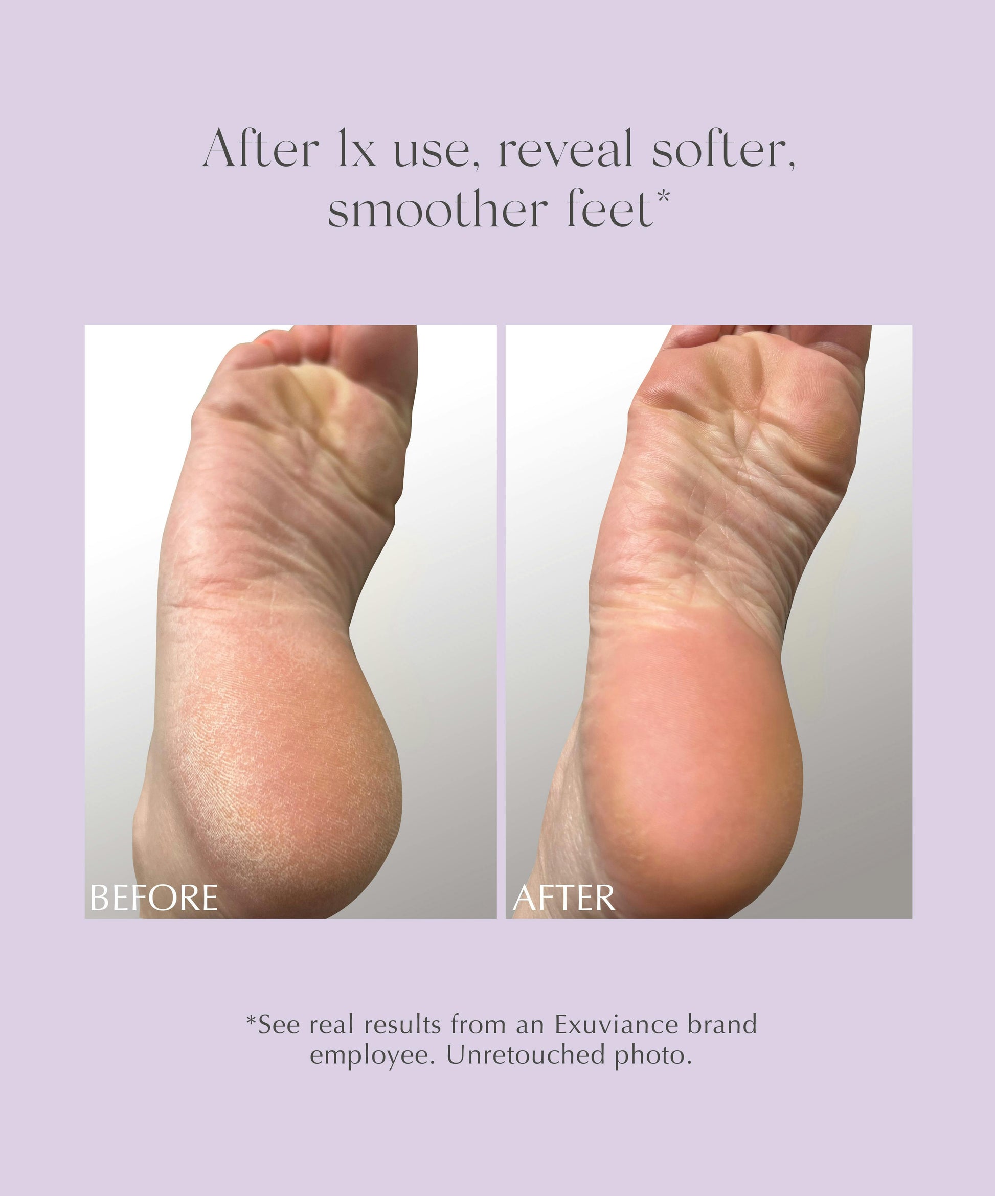 Heel Balm Soften Heels On Feet Chemical Peel For Cracked Heels
