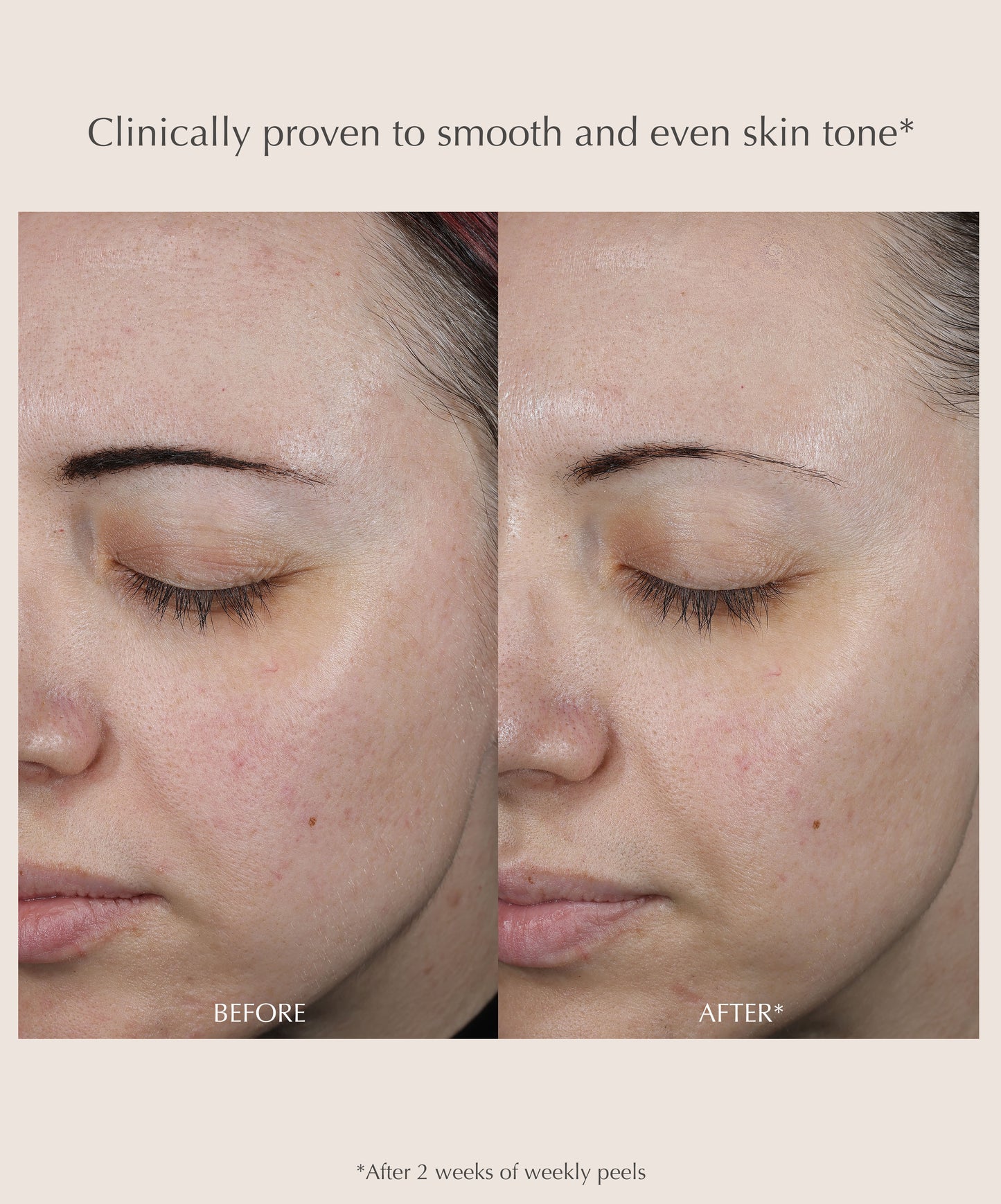 Performance Peel AP25 At-Home Chemical Peel