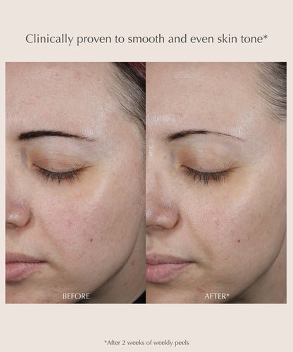 Performance Peel AP25 At-Home Chemical Peel